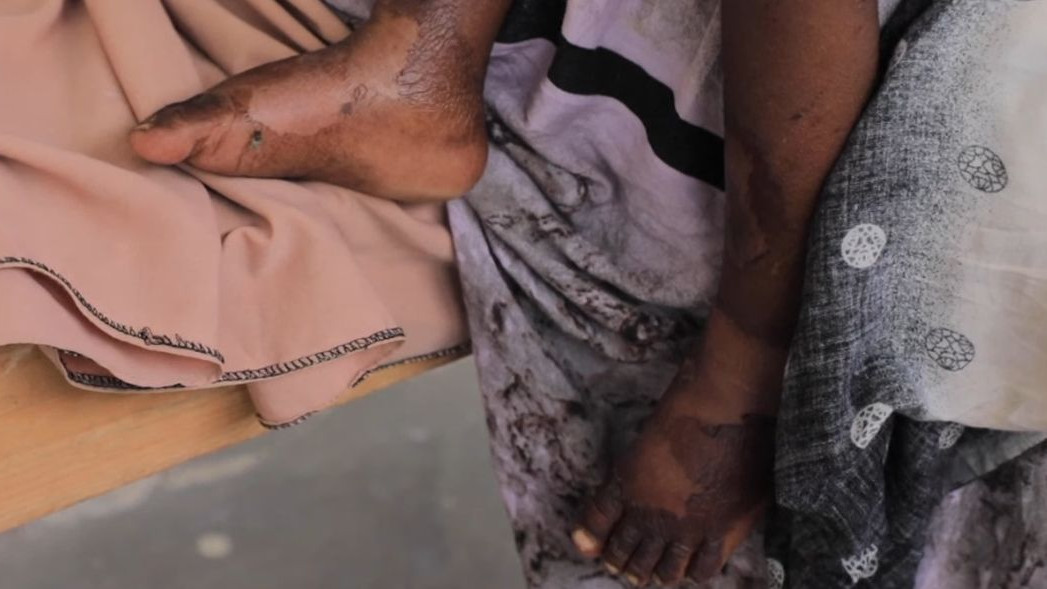 В Сомалия 45% от населението е на ръба на глада