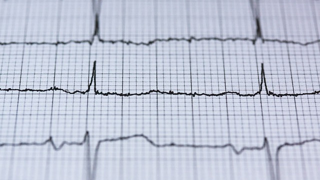 Изкуственият интелект  открива промени в електрокардиограмите, невидими за лекар