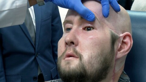 Първата трансплантация на цяло око в света продължи 21 часа