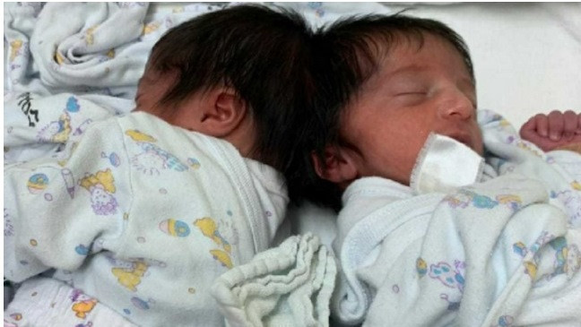 В Израел за първи път разделиха главите на сиамски близнаци