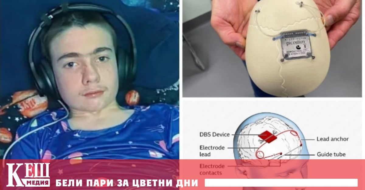 Операцията на 12 годишния Оран Ноулсън е извършена през октомври в