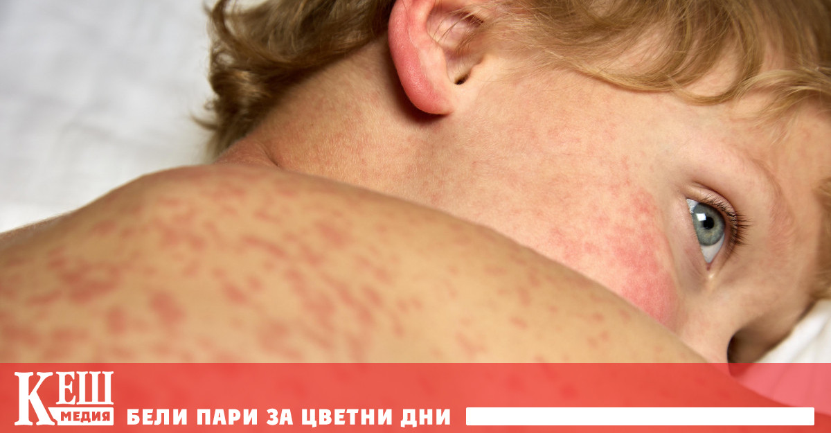 Миналия месец са регистрирани шест случая на зараза с морбили