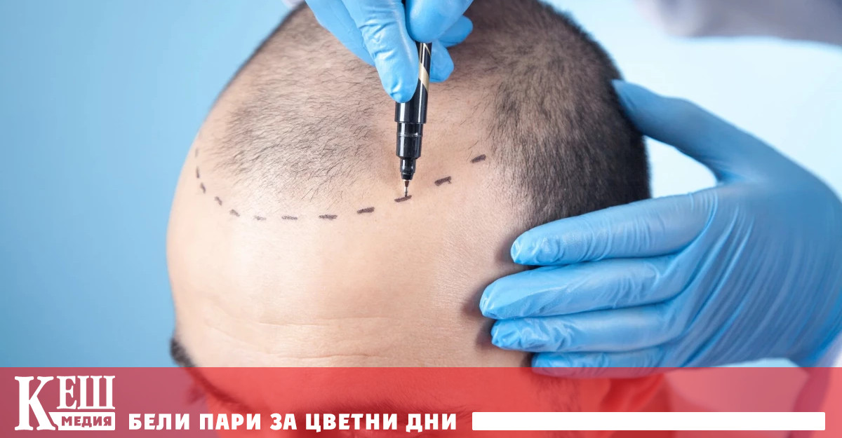 Както при денталния туризъм трансплантацията на коса е драстимно по