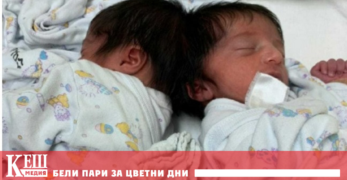 В Израел за първи път разделиха главите на сиамски близнаци