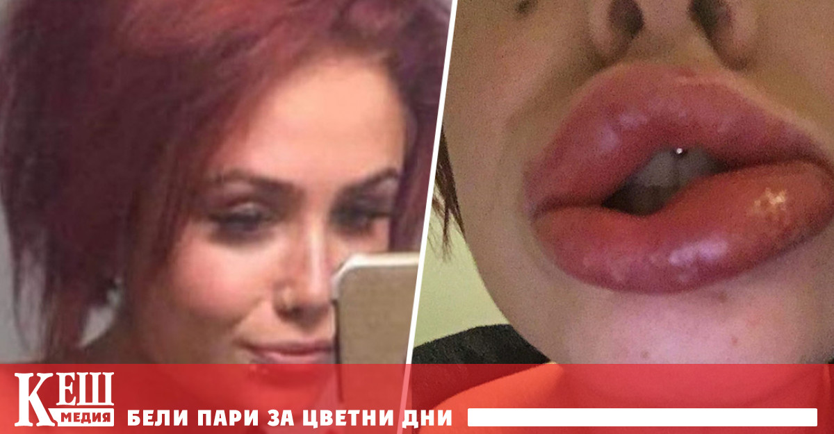 Без ботокс и увеличени устни преди 18- годишна възраст