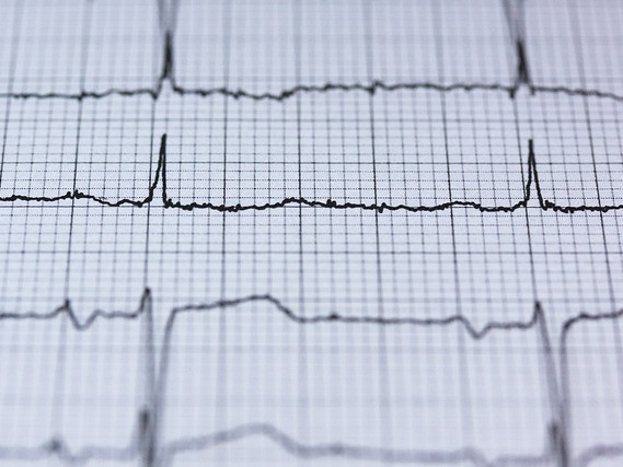 Изкуственият интелект  открива промени в електрокардиограмите, невидими за лекар