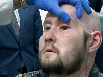 Първата трансплантация на цяло око в света продължи 21 часа