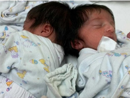 В Израел за първи път разделиха главите на сиамски близнаци